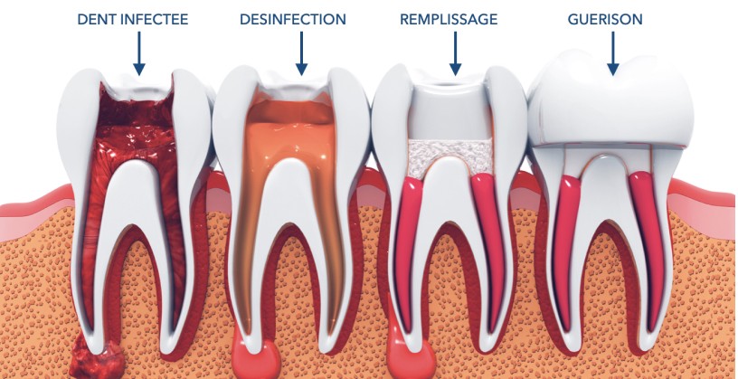 La dent est infectée ou déjà traitée