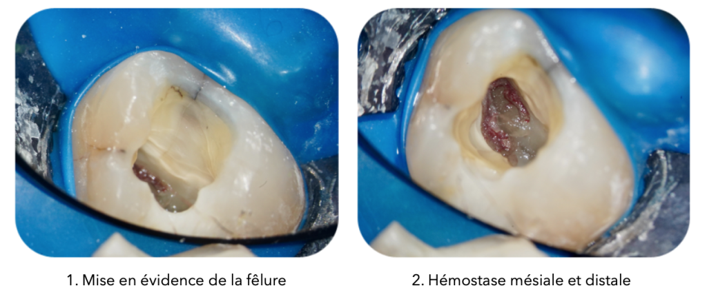 Deux photos côte à côte montrant les étapes d'une pulpotomie totale : à gauche, mise en évidence d'une fêlure sur une dent isolée avec une digue bleue ; à droite, hémostase mésiale et distale après traitement, avec un tissu pulpaire bien pigmentée.