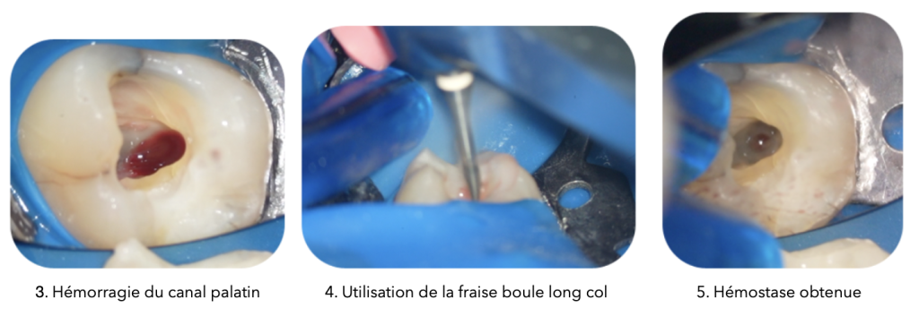 Trois photos côte à côte montrant les étapes d'une hémostase lors de la réalisation d'une pulpotomie totale : à gauche, une hémorragie du canal palatin visible sur une dent isolée avec une digue bleue ; au centre, utilisation d'une fraise boule long col Endotracer, avec un gros plan sur l'outil en action ; à droite, hémostase obtenue, montrant une cavité propre et préparée après intervention.