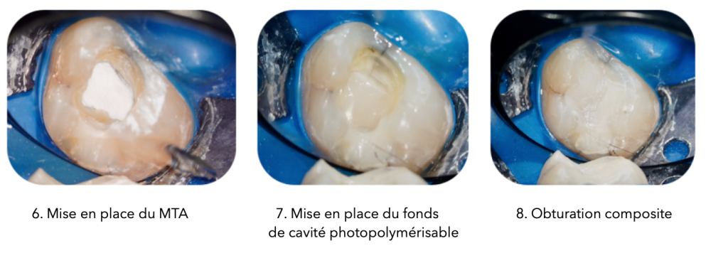 Trois photos côte à côte illustrant les étapes finales d'une pulpotomie : à gauche, mise en place du MTA (Mineral Trioxide Aggregate) sur une dent isolée à l'aide d'une digue bleue ; au centre, application de l'Hi-Seal pour isoler le MTA ; à droite, obturation réalisée avec un composite collé.