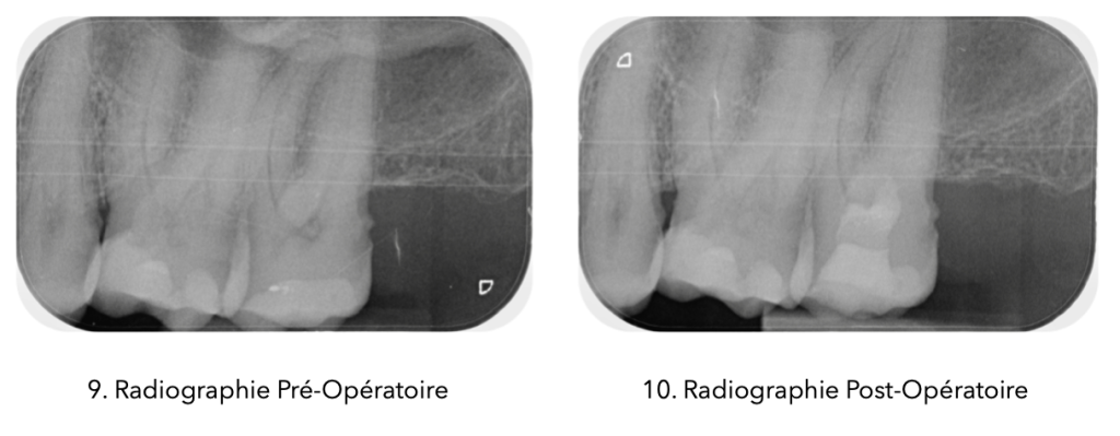 Deux radiographies dentaires comparatives avant et après le traitement : à gauche, une radiographie pré-opératoire montrant la dent avant intervention ; à droite, une radiographie post-opératoire montrant la dent restaurée après le traitement, avec un aspect normalisé et une obturation visible.