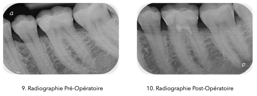 Deux radiographies côte à côte montrant l'avant et l'après du traitement : à gauche, radiographie pré-opératoire illustrant l'état initial des dents, avec des signes de pathologie visibles ; à droite, radiographie post-opératoire montrant le résultat après intervention, avec la dent restaurée et des obturations bien visibles.