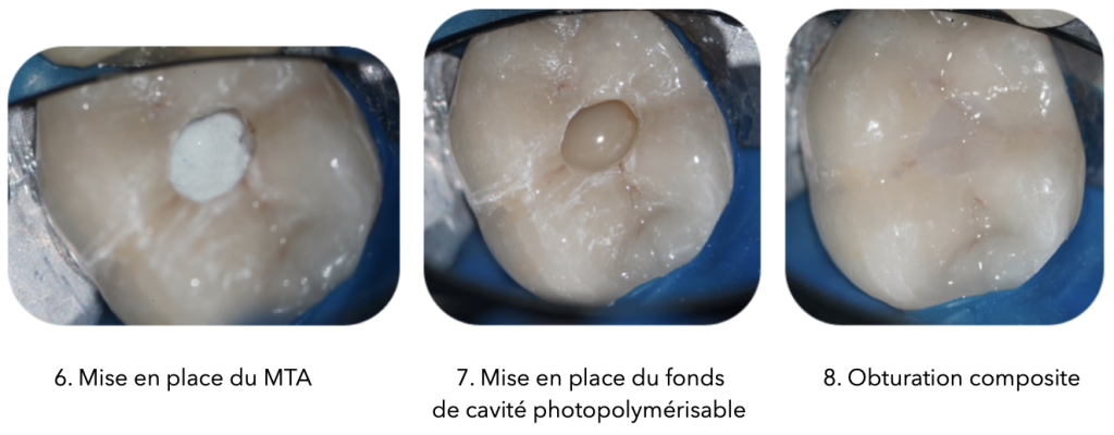 Trois photos côte à côte montrant les étapes finales d'une pulpotomie totale : à gauche, mise en place du MTA (Mineral Trioxide Aggregate) dans la cavité de la dent ; au centre, application de l'Hi-Seal pour sceller la cavité ; à droite, obturation finale réalisée avec un composite foulé, montrant une restauration complète et homogène.