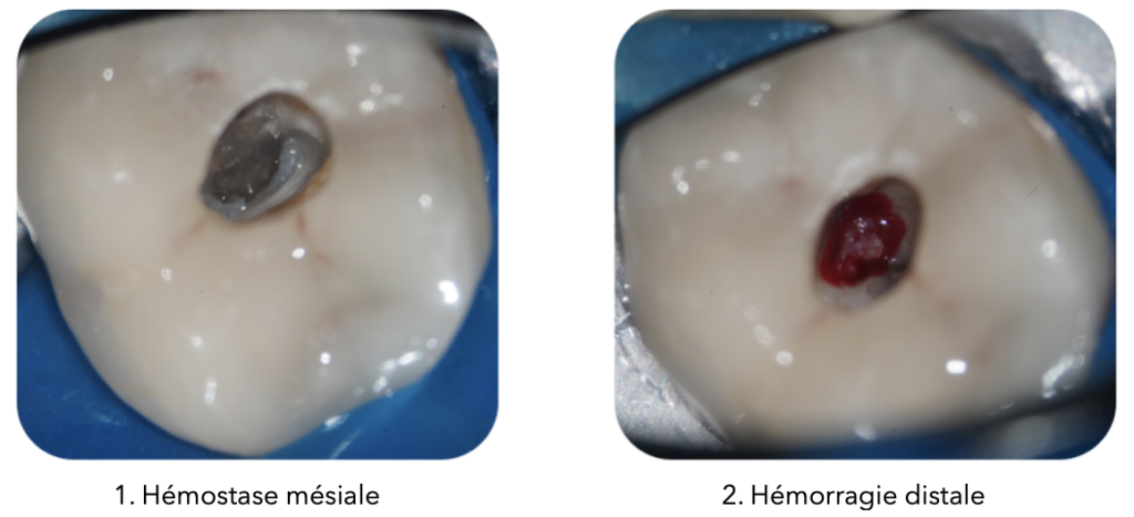 Deux photos côte à côte montrant les étapes d'une pulpotomie totale : à gauche, hémostase mésiale réalisée avec un aspect propre et contrôlé ; à droite, hémorragie distale visible avec une cavité rougeâtre sur la dent isolée à l'aide d'une digue bleue.