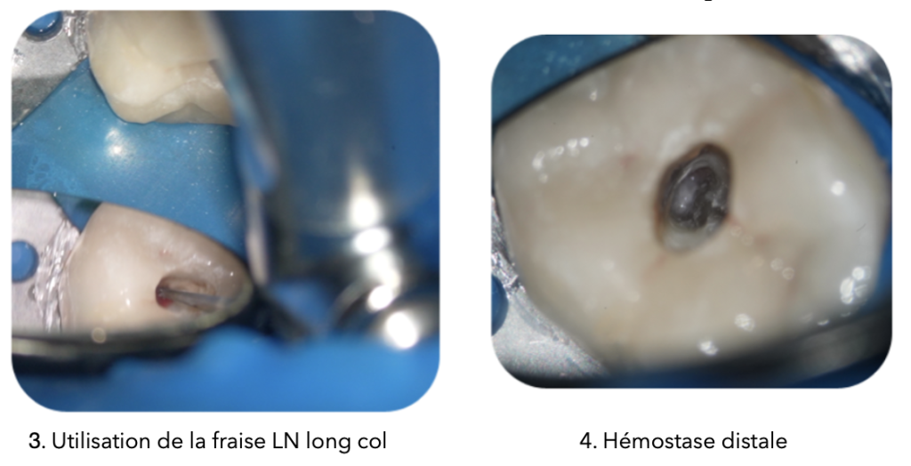 Deux photos côte à côte illustrant les étapes d'une pulpotomie totale : à gauche, utilisation de la fraise LN long col pour l'accès à la cavité pulpaire sous digue bleue ; à droite, vue de l'hémostase distale réalisée, montrant une cavité propre et bien préparée.