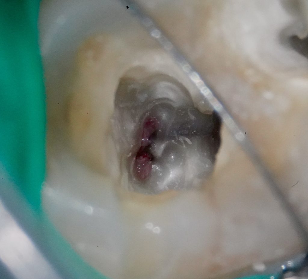 Chambre pulpaire ouverte avec émergence de tissu pulpaire résiduel hémorragique après débridement partiel, suggérant un stade de pulpite chronique mais encore vascularisé.