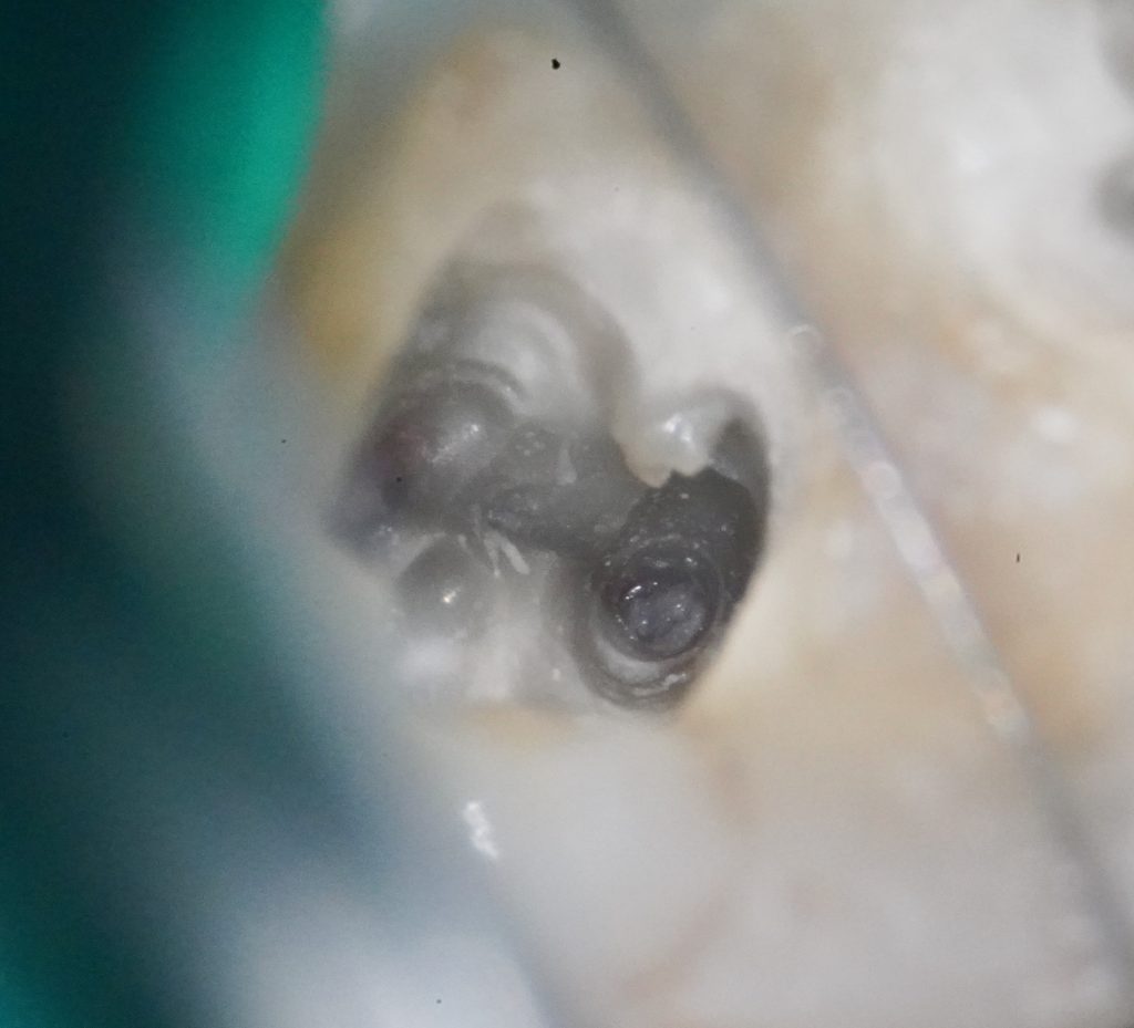 Vue intraorale sous digue dentaire montrant une chambre pulpaire ouverte, avec tissu pulpaire visiblement nécrosé et coloration noirâtre, évocatrice d'une dégénérescence pulpaire avancée.