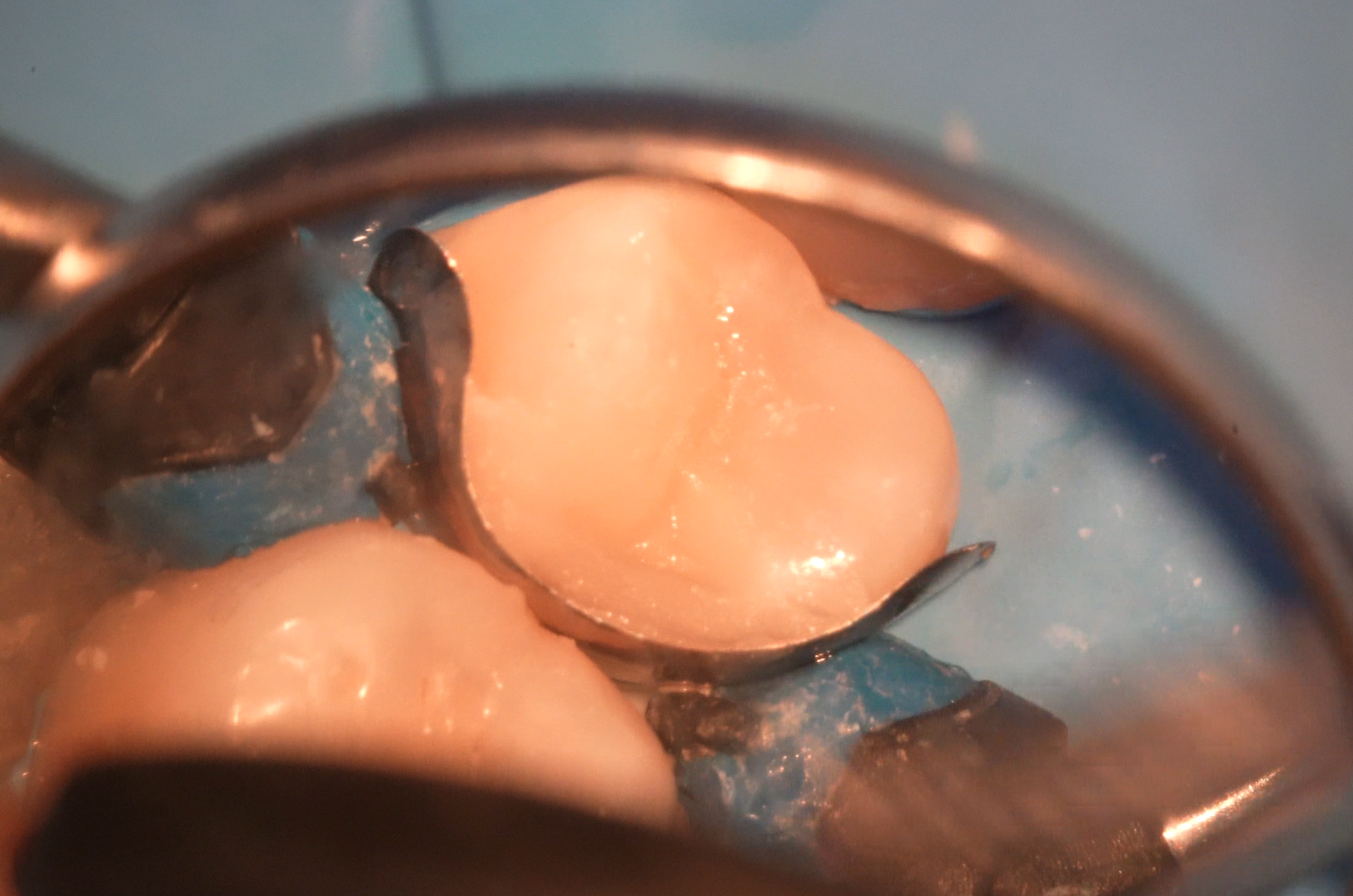 Obturation coronaire définitive en composite après coiffage pulpaire direct sur la 25