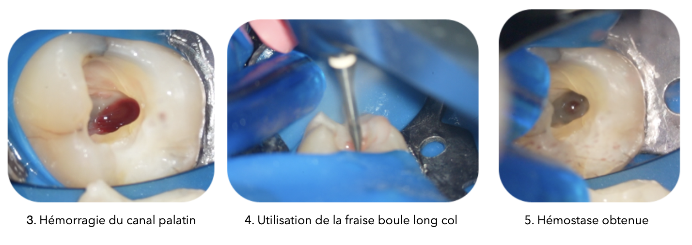 Cas clinique pulpotomie totale sur pulpite irréversible avec hémostase mécanique