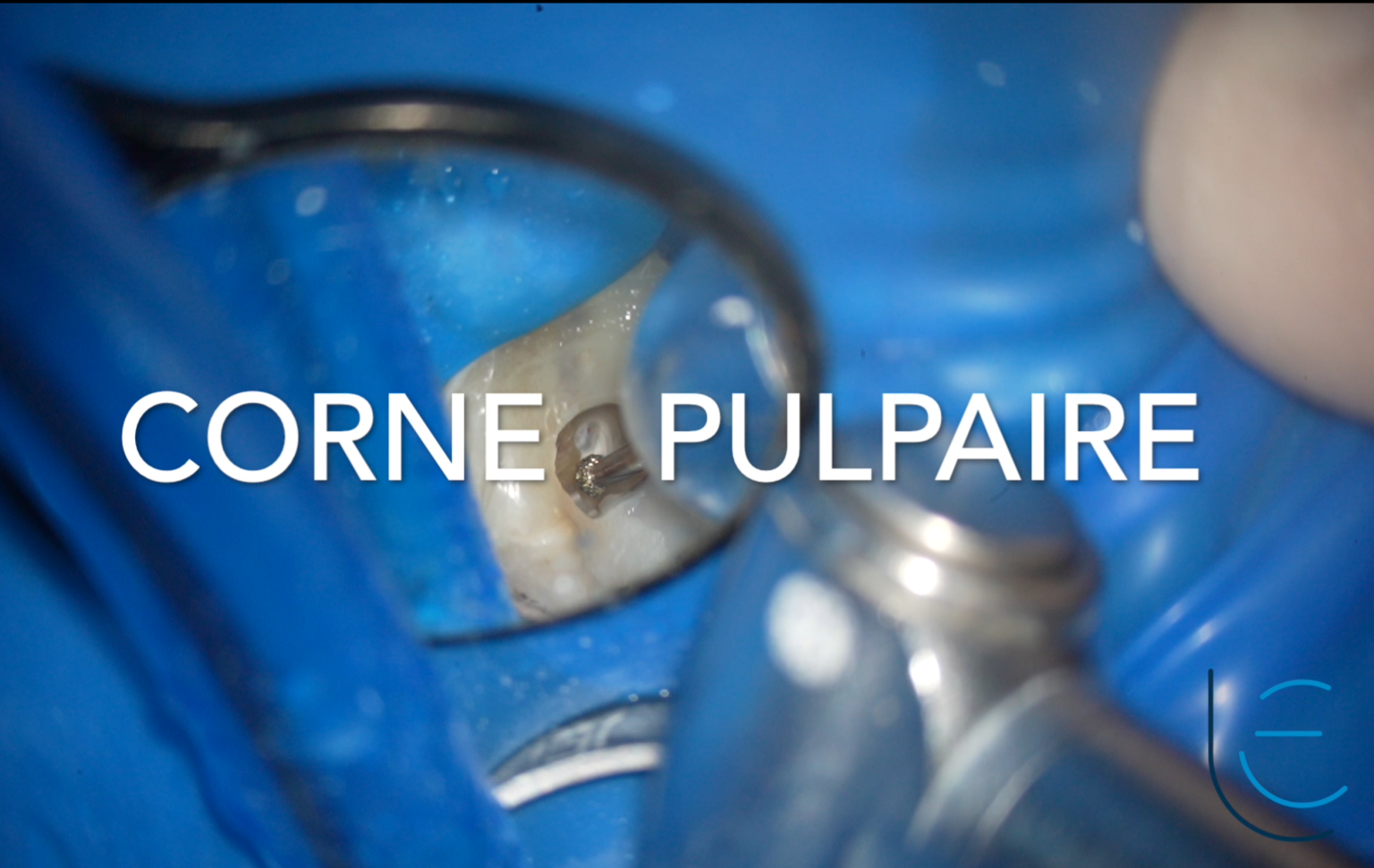 Cas clinique pulpotomie totale sur 17 : avant/après avec MTA Komet BioRepair