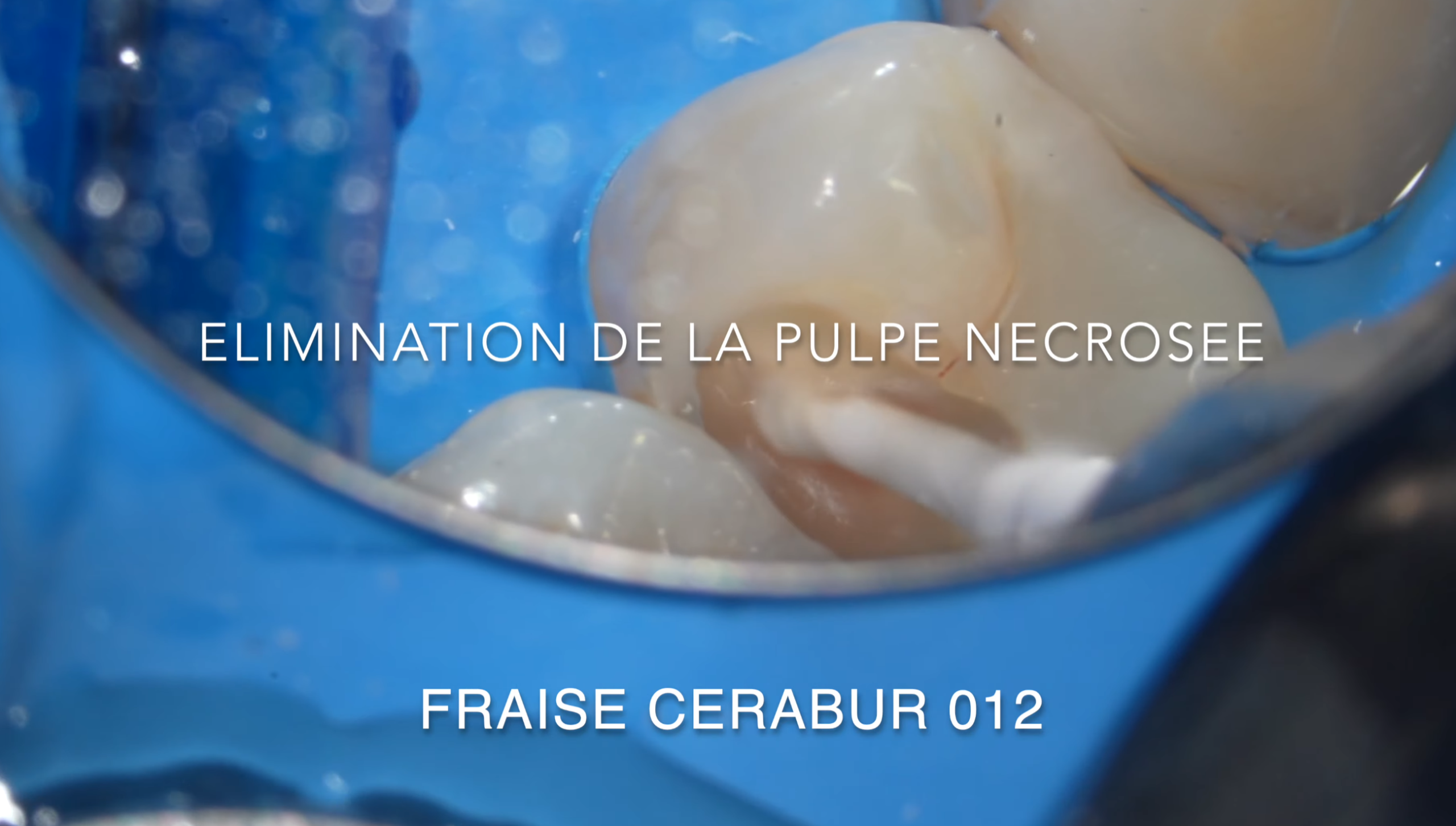 Curetage carieux à la fraise Cerabur Komet sous digue pendant un coiffage pulpaire direct