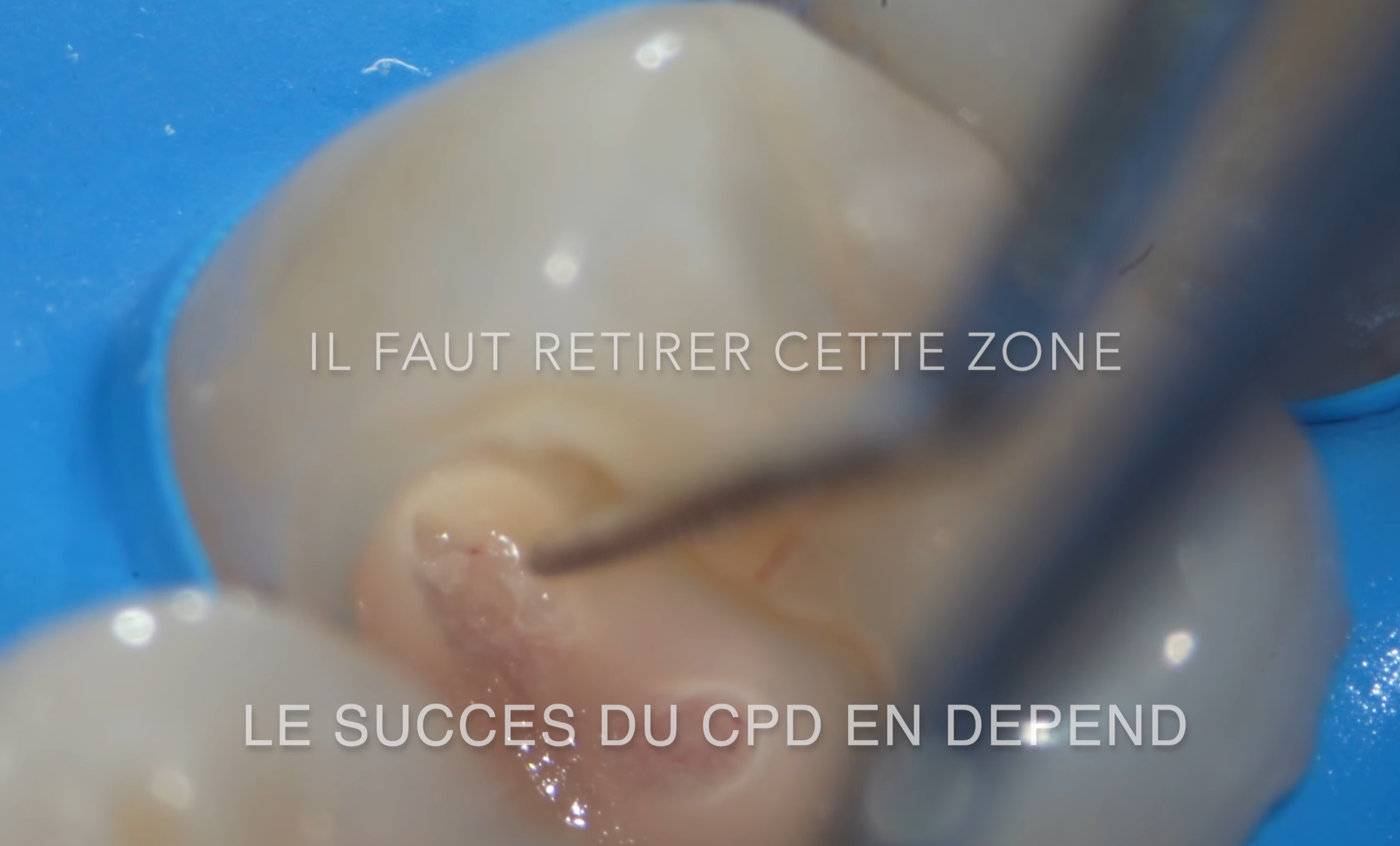 Effraction pulpaire visualisée sous microscope après éviction carieuse complète sur la 25