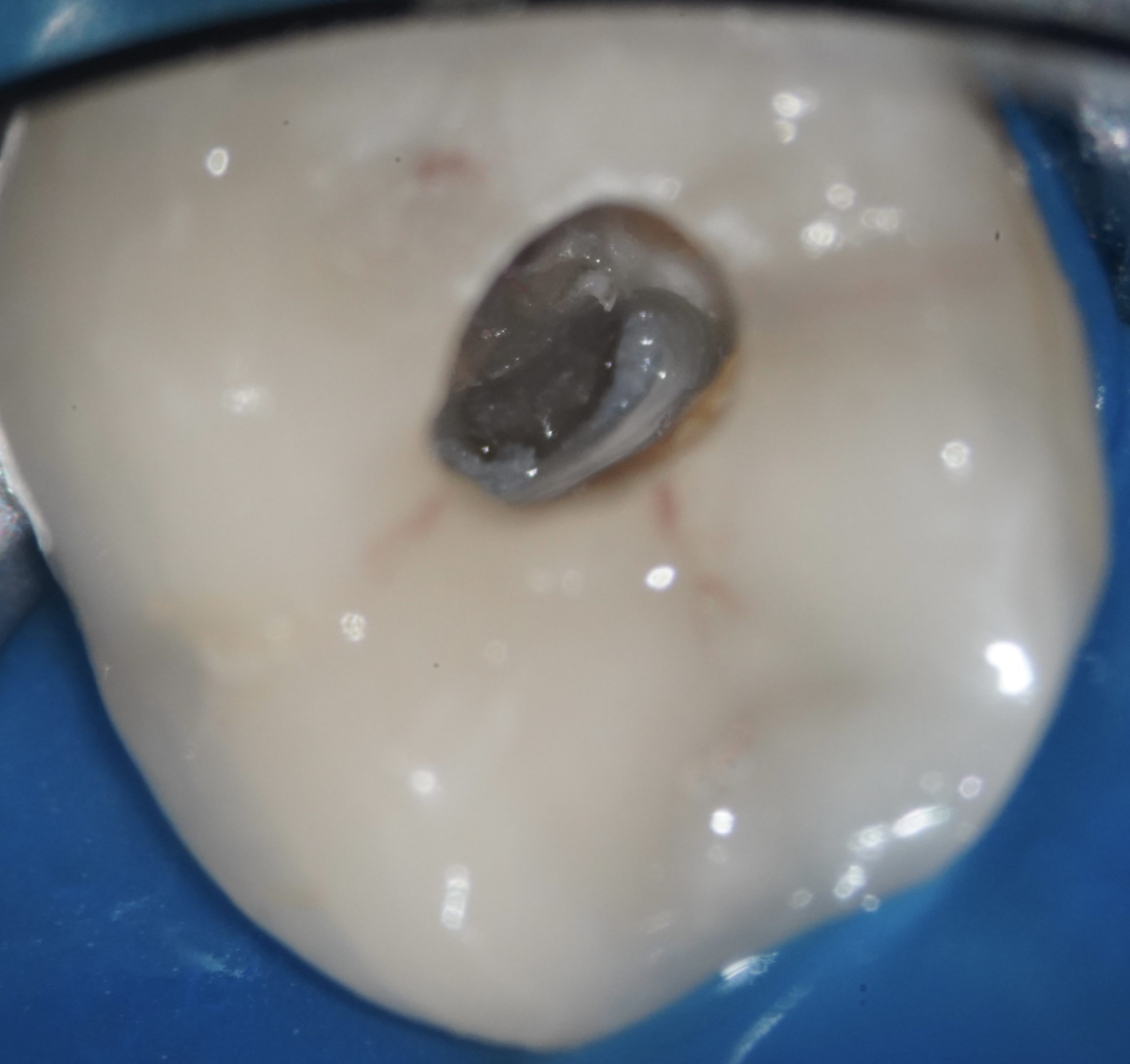 Cas clinique pulpite chronique avec dégénérescence pulpaire : contre-indication de la pulpotomie