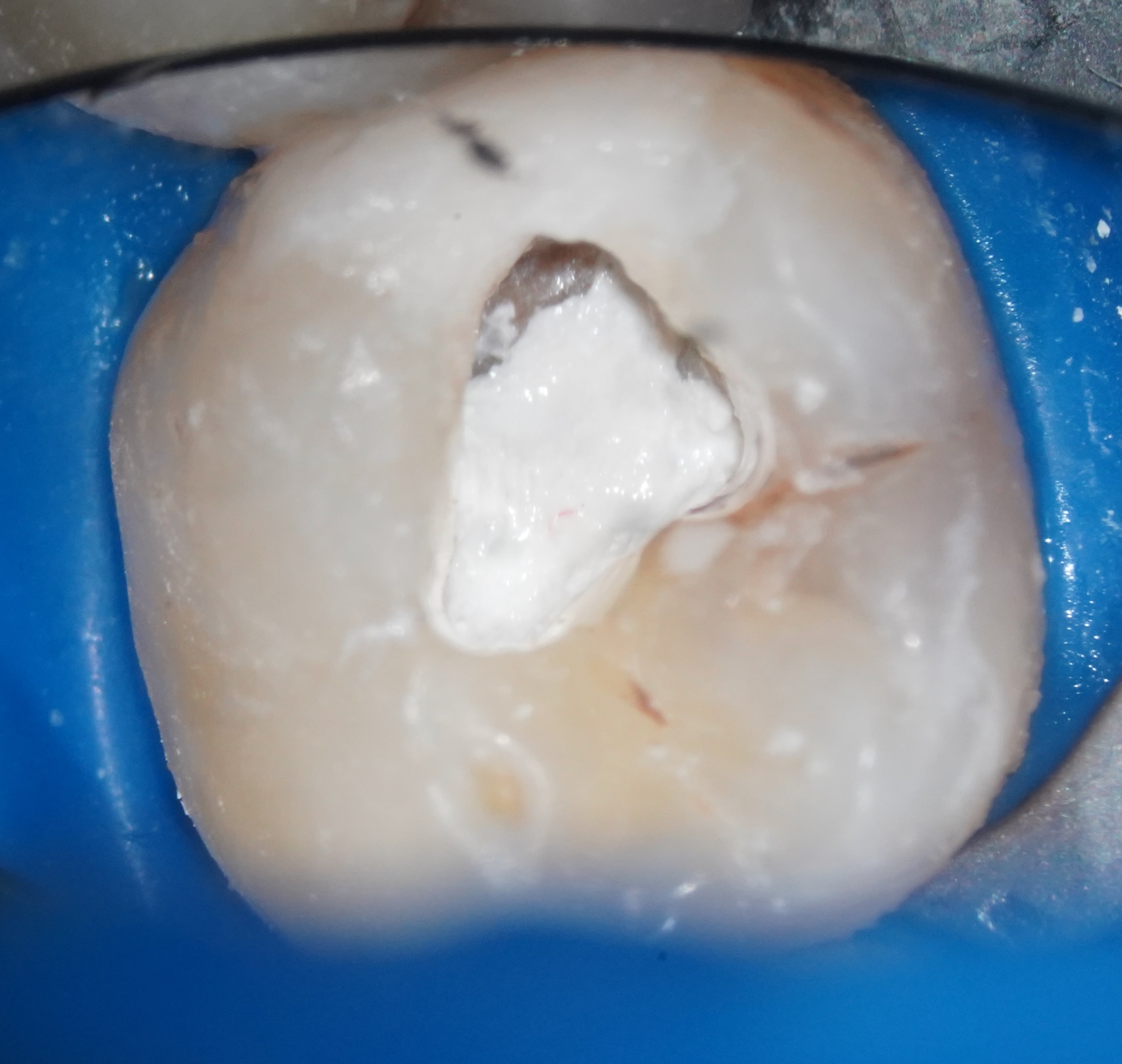Mise en place du MTA en pulpotomie : épaisseur de 3 mm sur les orifices canalaires