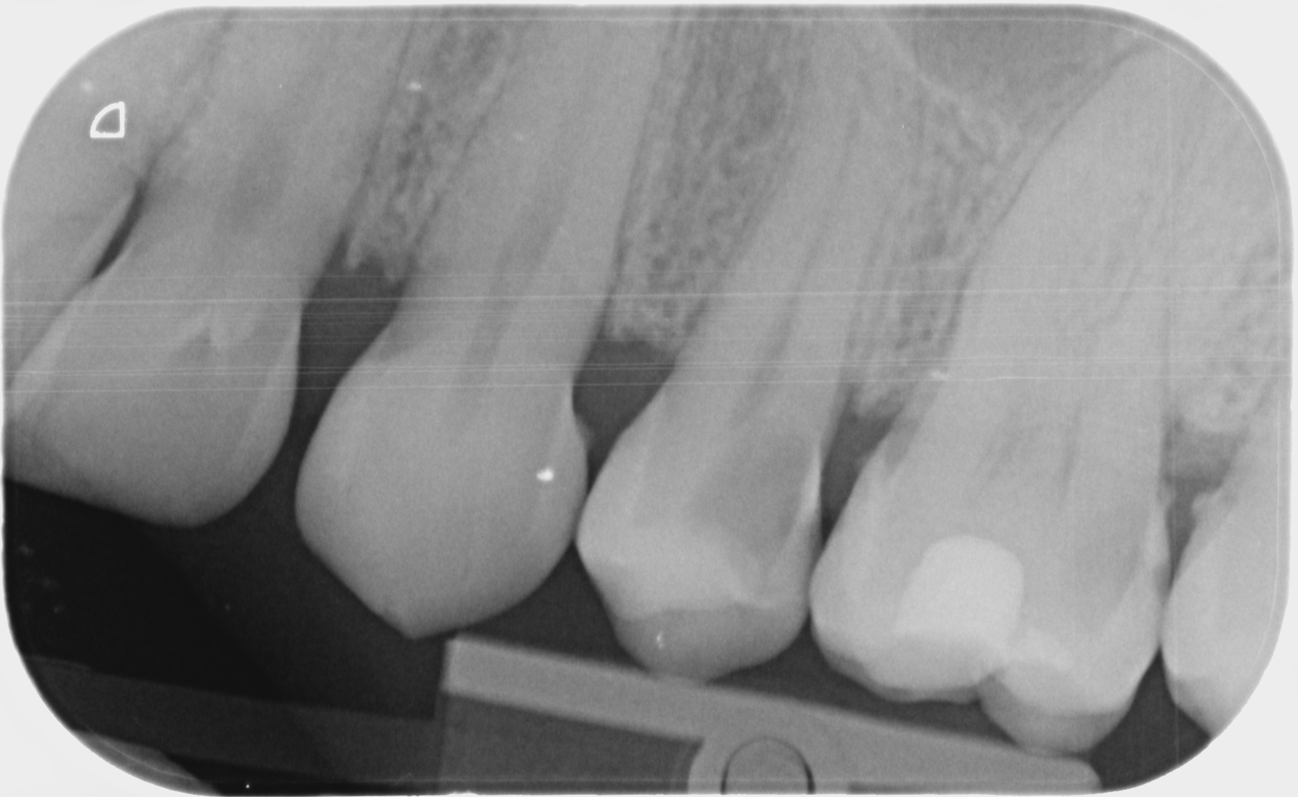 Radiographie périapicale préopératoire montrant une carie juxta-pulpaire sur la 25 avant coiffage pulpaire direct