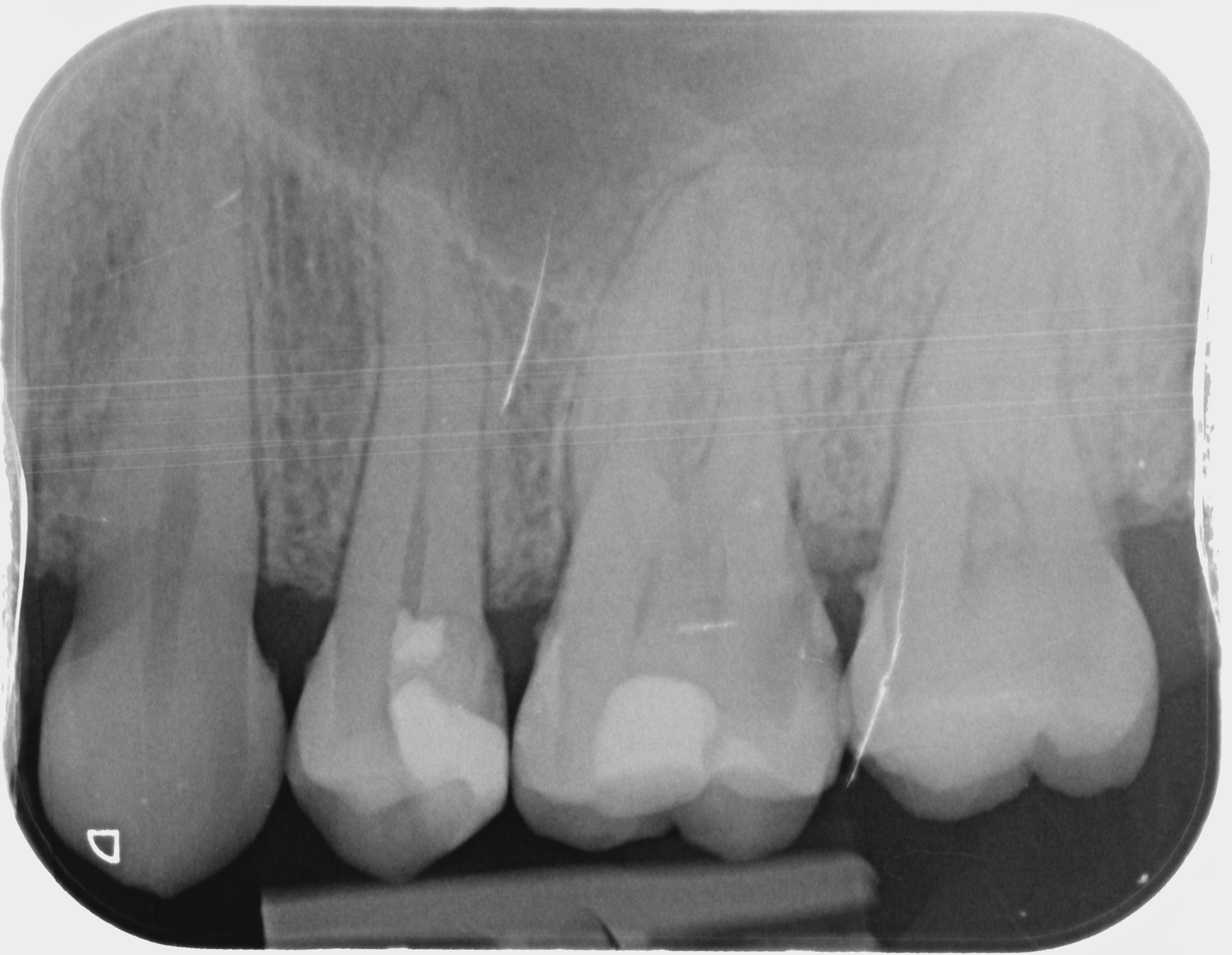 Radiographie postopératoire montrant le coiffage pulpaire direct et la restauration composite sur la 25