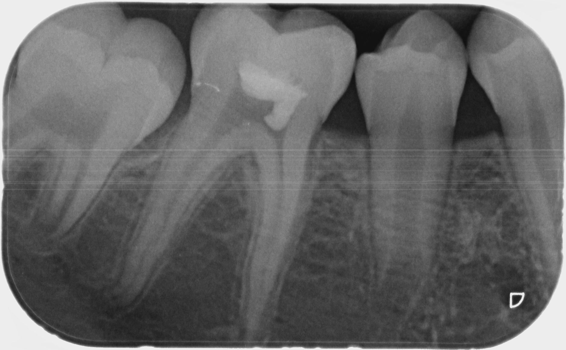 Pulpotomie partielle de Cvek : ablation des 2-3 mm superficiels de pulpe camérale exposée
