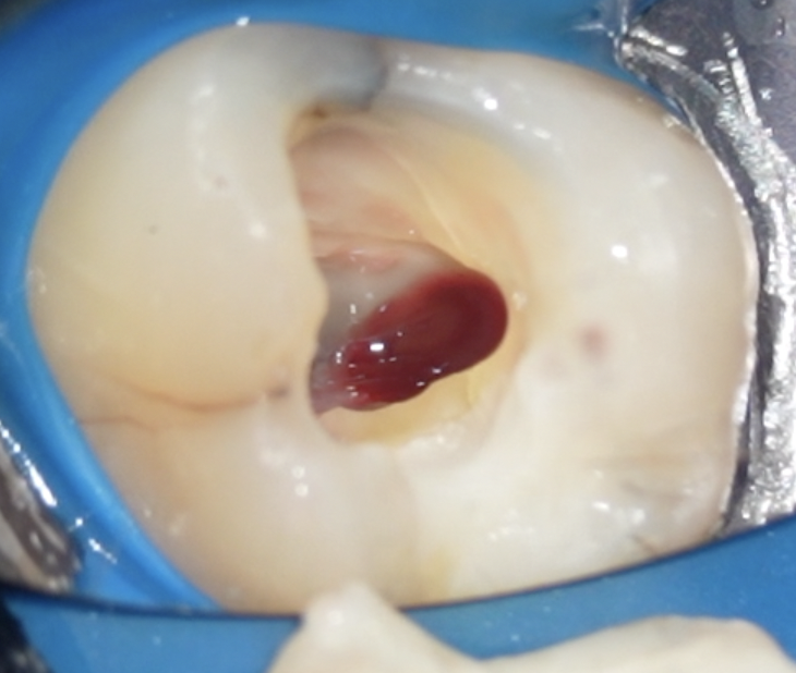 Pulpotomie tampon : application du biomatériau directement sur une pulpe hémorragique