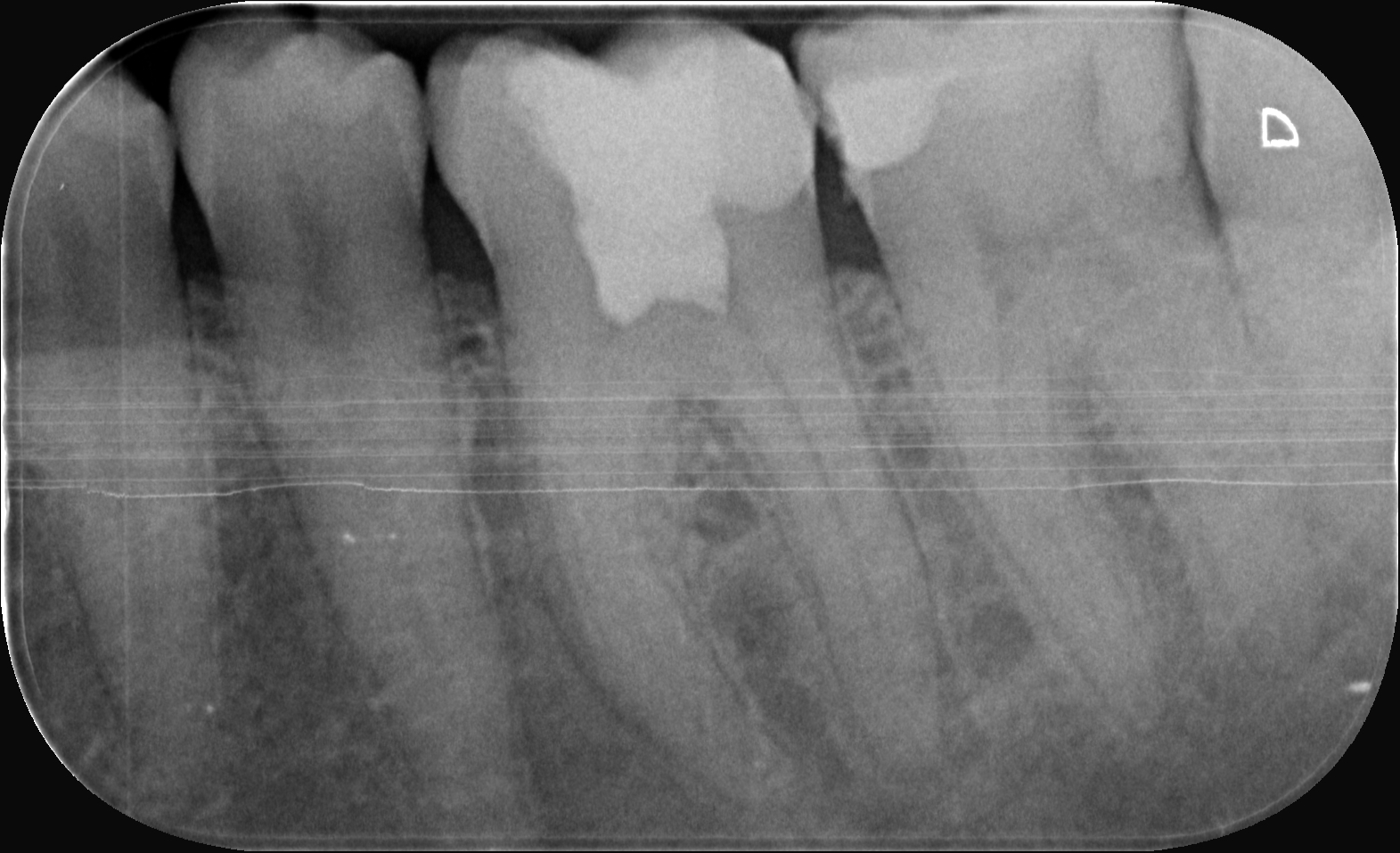 Pulpotomie totale : ablation complète de la pulpe camérale jusqu'aux orifices canalaires